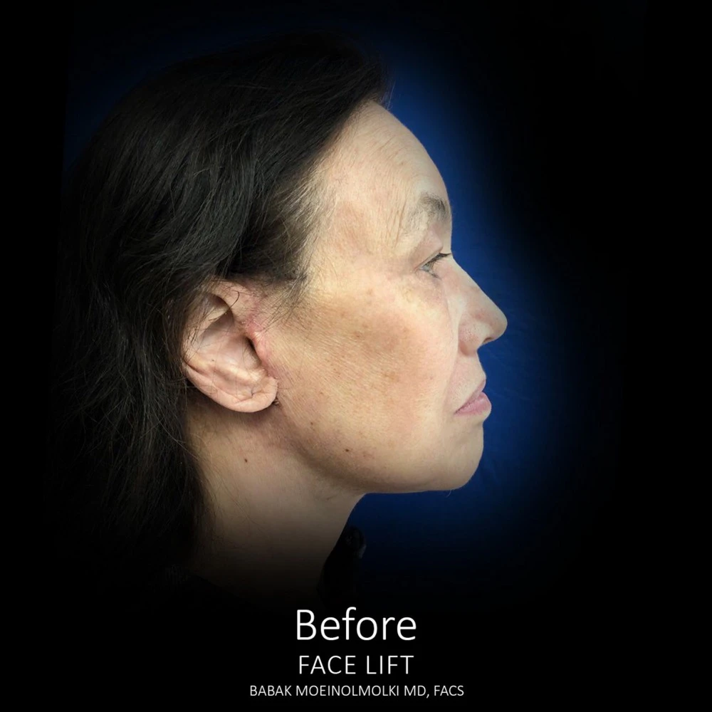 A woman's face transformation after a face lift.