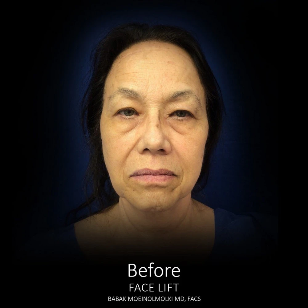 A woman's face transformation following a face lift, illustrating the before and after.