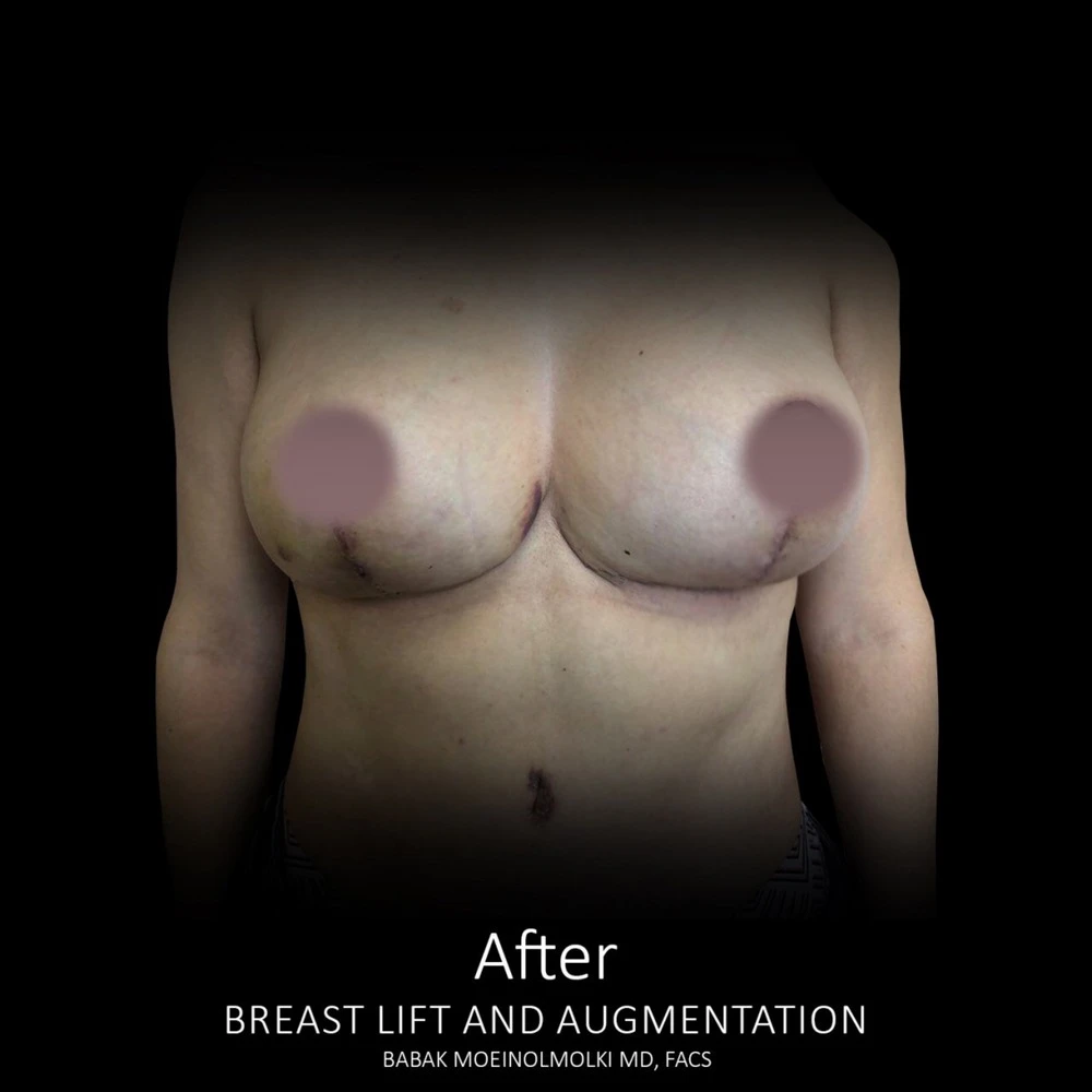 Breast Lift Before and After: Transformation of a woman's breast through lift and augmentation.