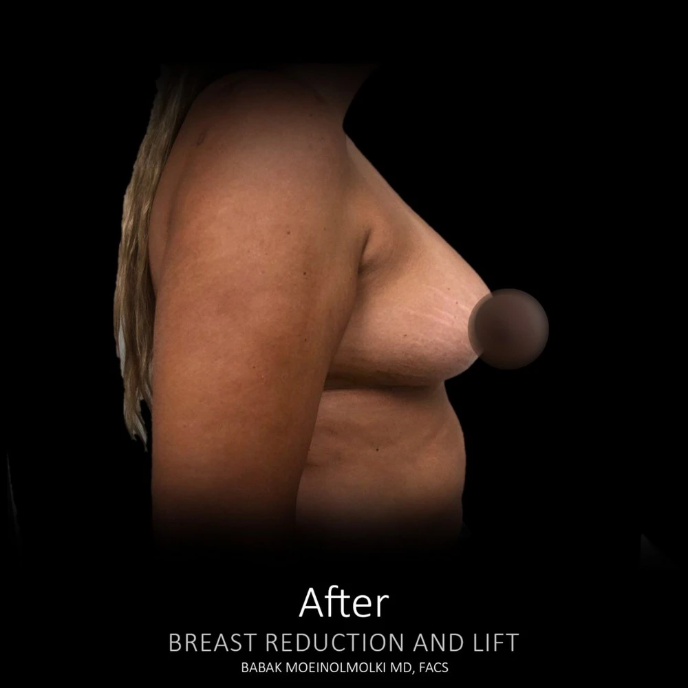 A woman's breast transformation, before and after breast reduction and lift.