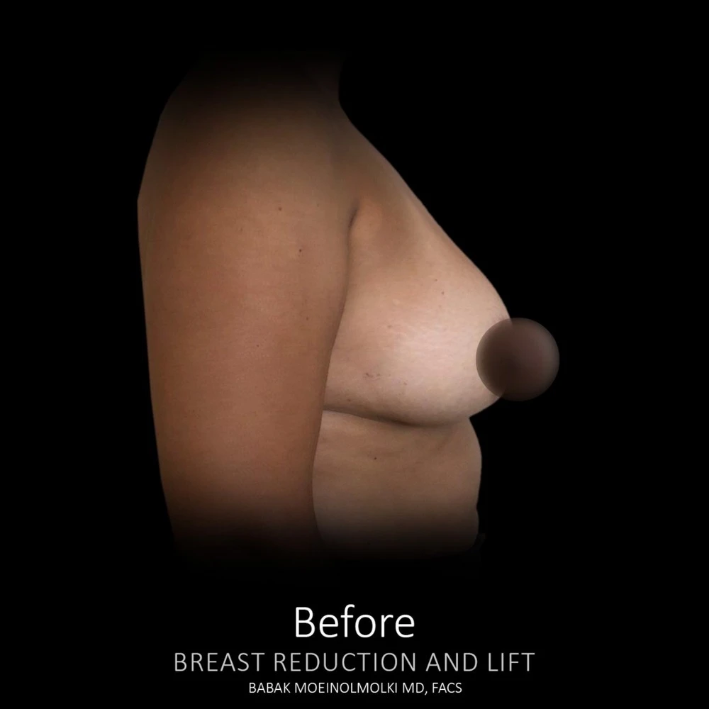 Breast Reconstruction Before and After