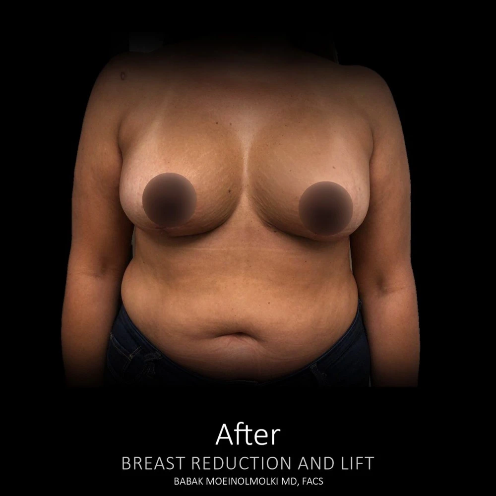 Before and after images showcasing a woman's breast transformation following a reduction and lift procedure.