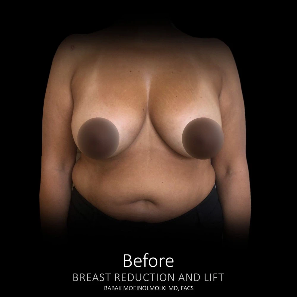 Before and after images showcasing breast reconstruction and lift.