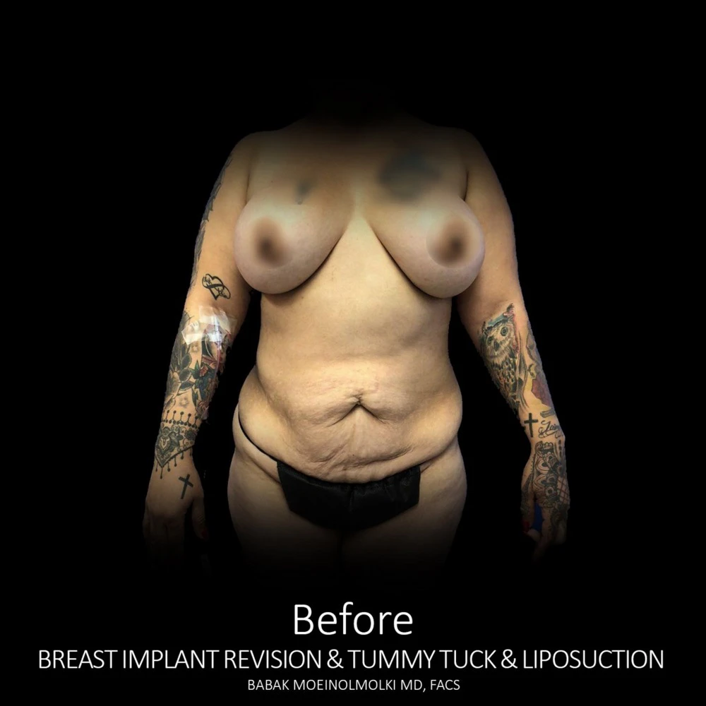 A woman's breast implant revision showcasing before and after pictures.