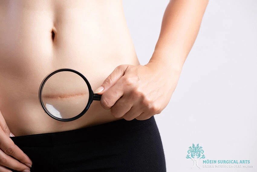 Risks and Complications of Liposuction