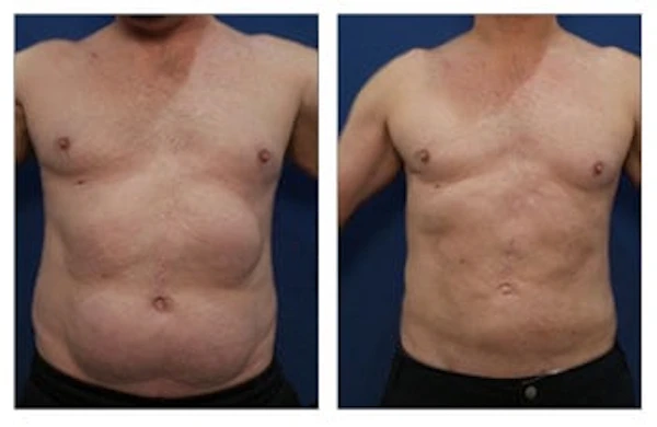 Man Liposuction