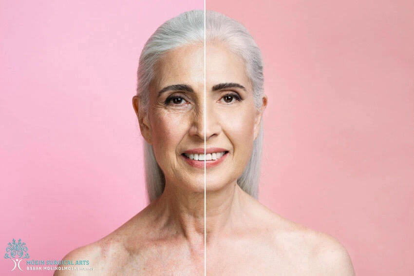 A woman with wrinkles before and after treatment.