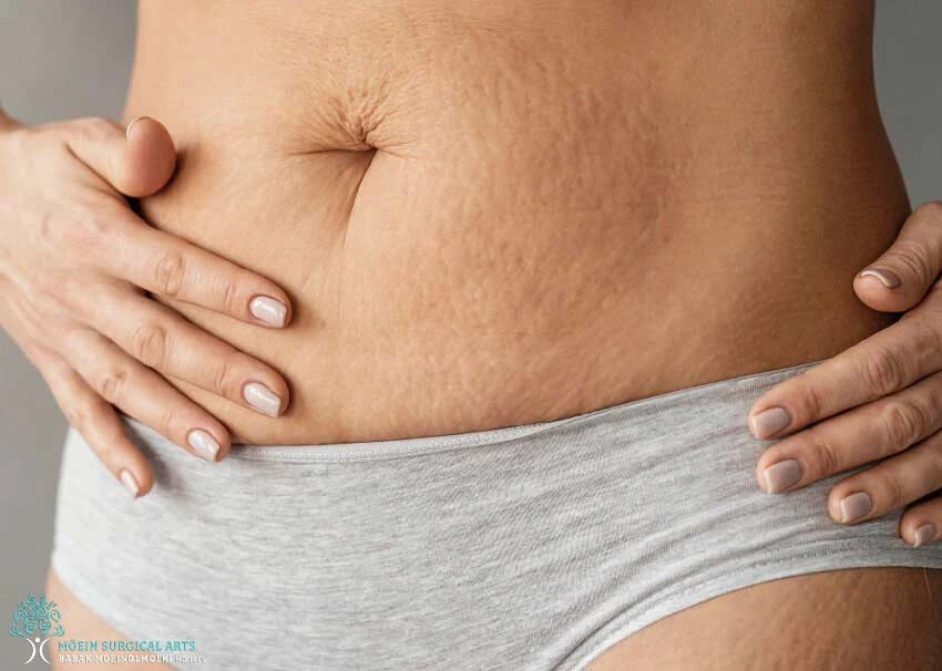 A woman's stomach is showing signs of cellulite.