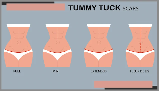 Tummy Tuck Vs. Liposuction, or both: What's the Right Choice for You?