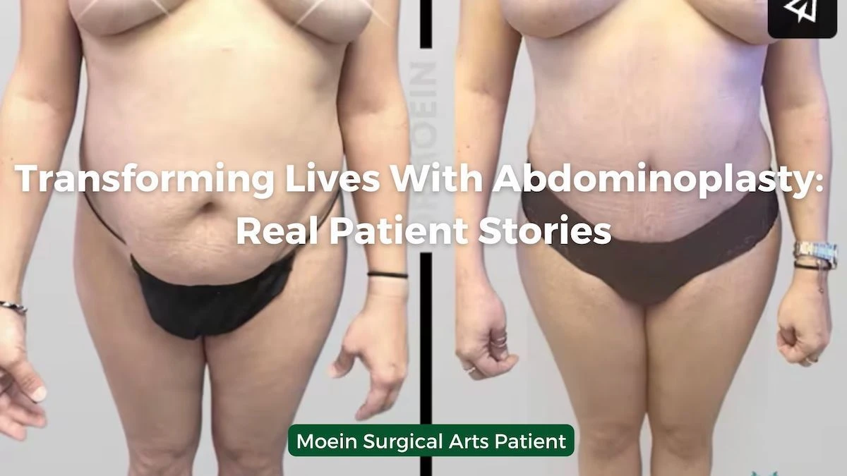 Transforming Lives With Abdominoplasty