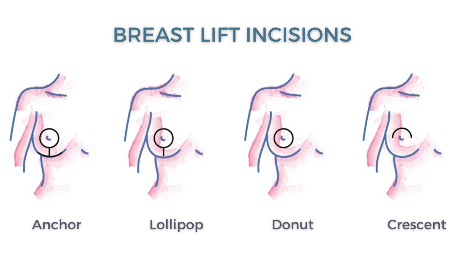 breast lift incisions 