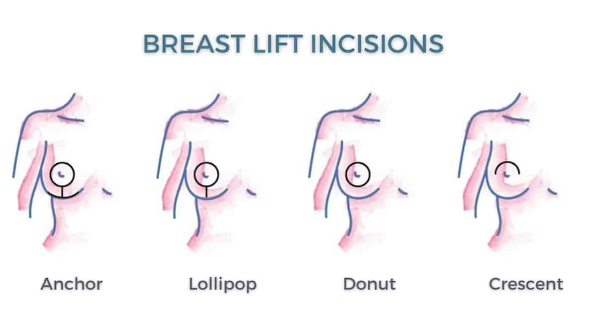 breast lift cosmetic rejuvenation