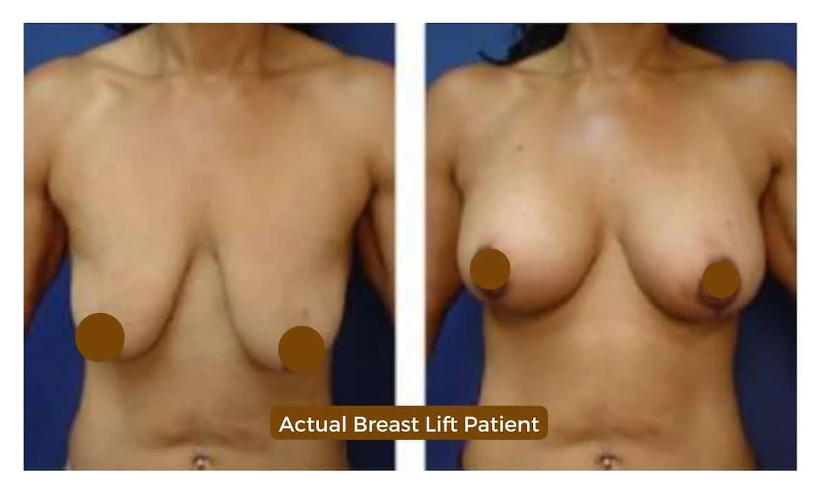 breast lift cosmetic rejuvenation