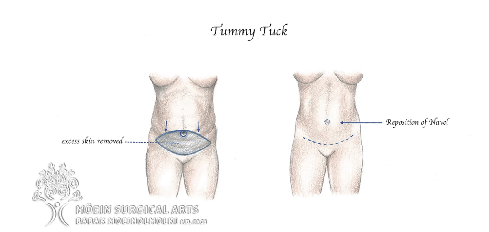 Transforming Lives With Tummy Tuck